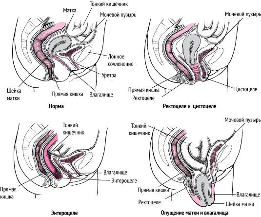 Опущение органов малого таза - признаки, диагностика, терапия.