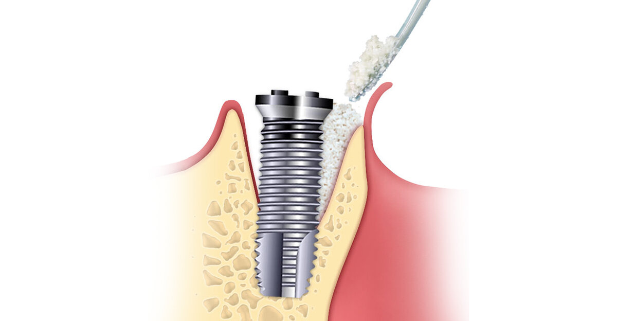 Подсадка костной ткани