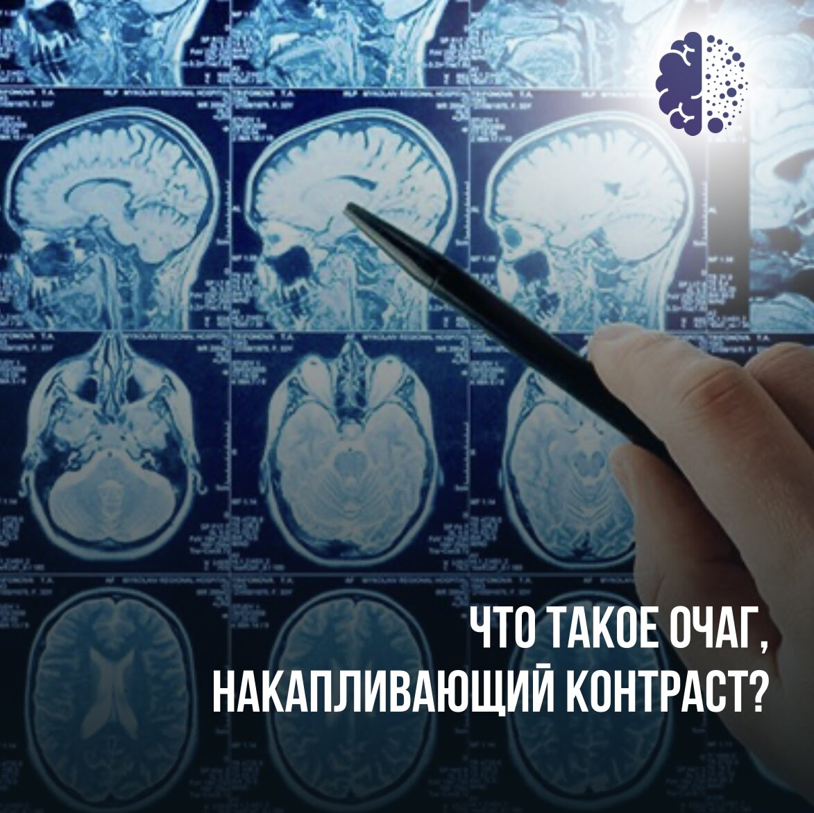 Что значит копишь. Рисунок как вводят контраст для дуктографии. Негативное пред контрастное изображение в медицине. Очаг в стволе мозга копит контраст на мрт.