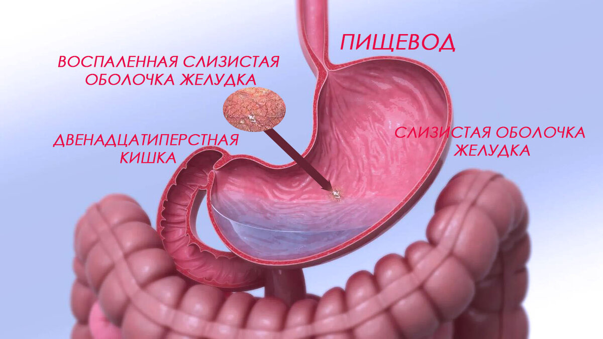 Весеннее обострение гастрита