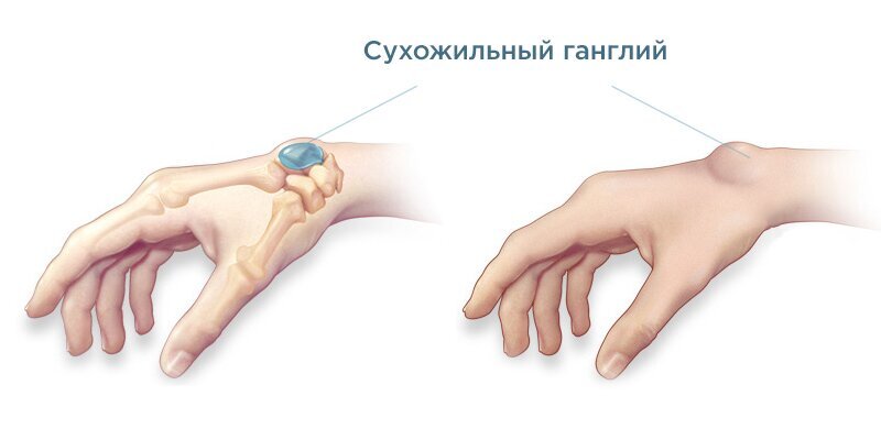 Что такое Гигрома? Причины, сипмтомы, признаки, лечение гигромы