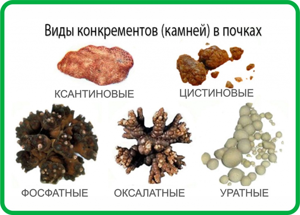 Классификация камней при мочекаменной болезни. Мочекаменная болезнь Ураты оксалаты. Уратные камни при мочекаменной болезни. Ураты фосфаты оксалаты мочекаменная болезнь.