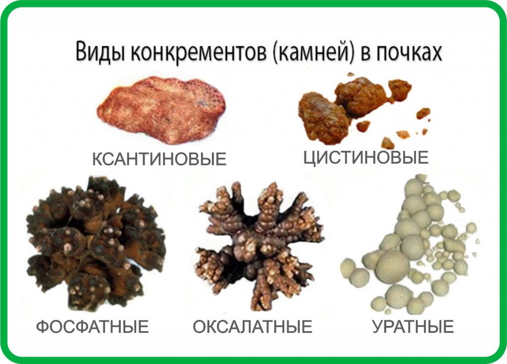 Ураты фосфаты оксалаты мочекаменная болезнь. Уратные камни при мочекаменной болезни. Оксалатные камни в почках состав.