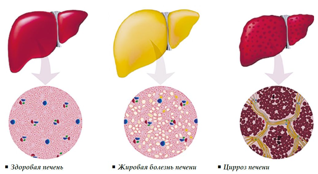 Повреждение клеток печени. Болезнь печени жировой гепатоз. Неалкогольный цирроз печени. Жировое Перерождение печени, цирроз печени. Жировой гепатоз и цирроз.