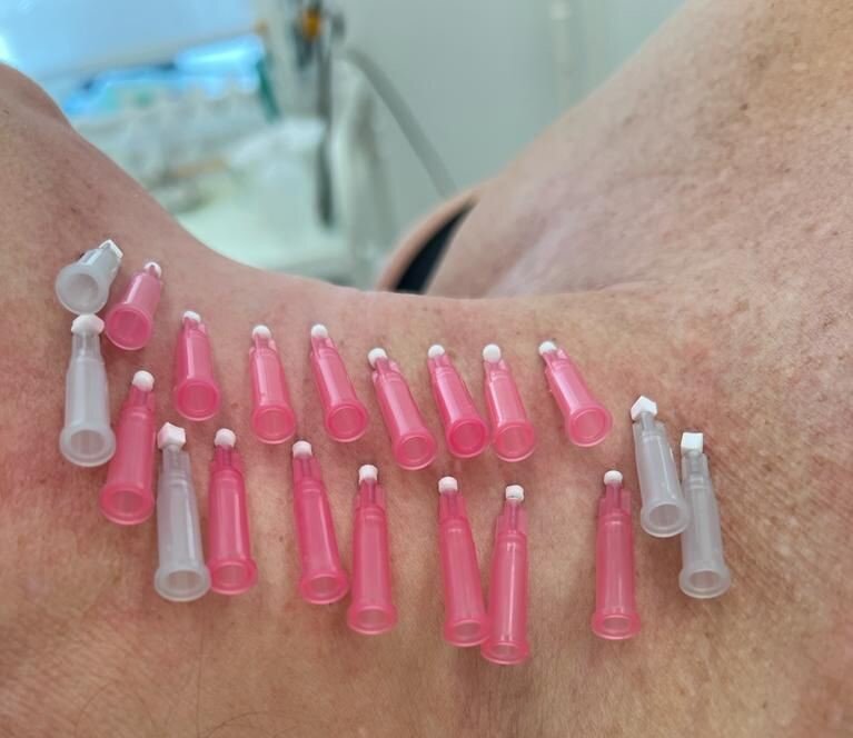 Мезонити в область шеи