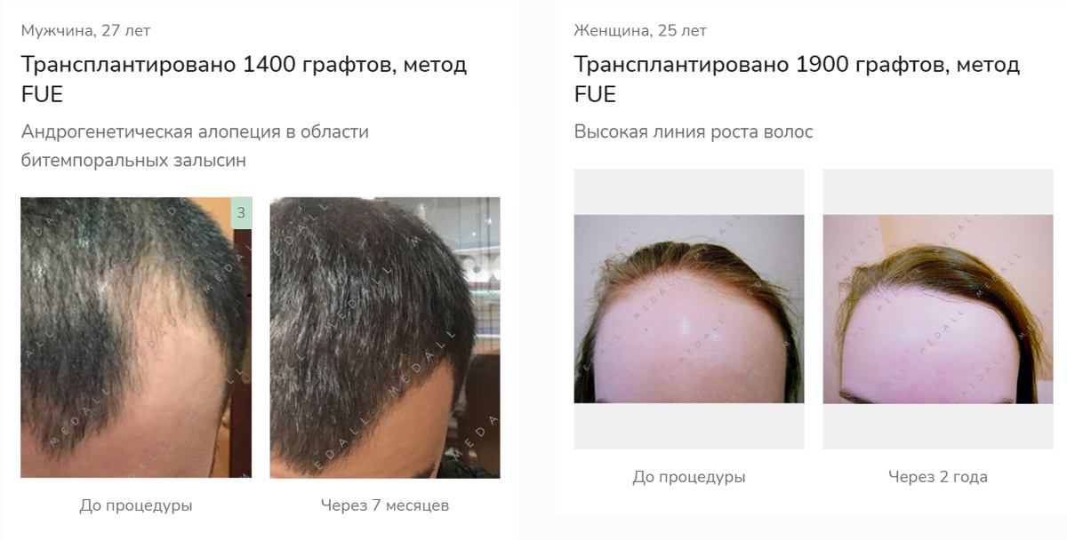 Результаты работ пересадки волос в клинике Medall