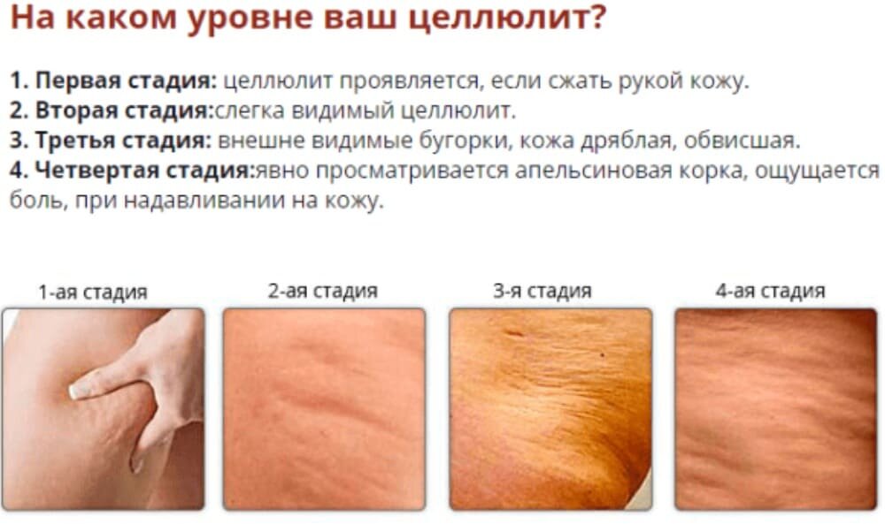 От чего появляется целлюлит. Причины появления целлюлита. Строение жировой ткани женщины. От чего появляется целлюлит. Целлюлит.