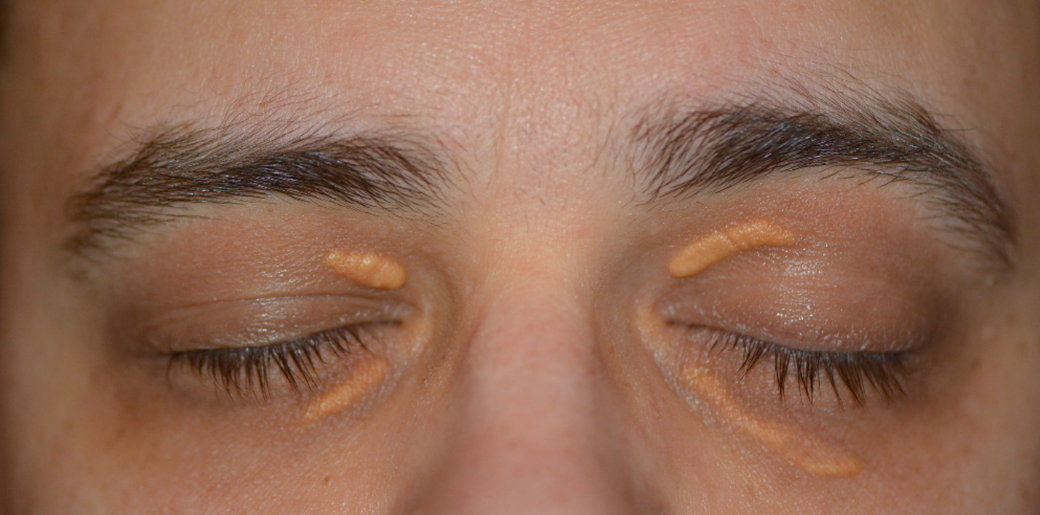 Ксантелазмы