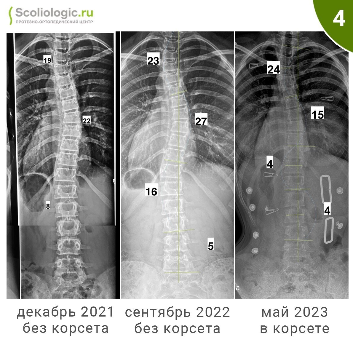 Сколиоз: симптомы, причины, диагностика и лечение