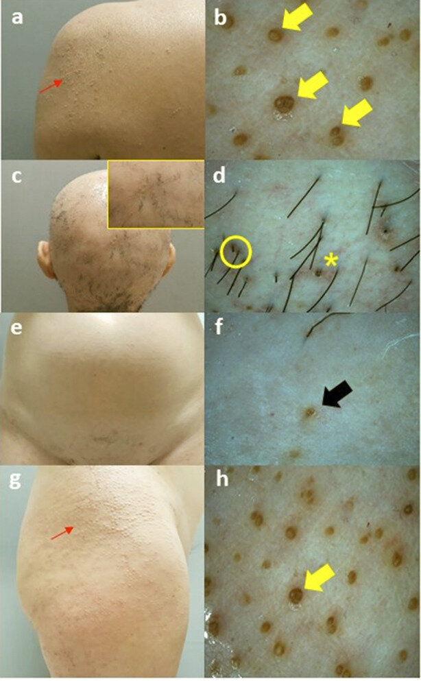 Клинические (слева) и дерматоскопические изображения:  a. Шиповидные папулы на коже левого плеча (красная стрелка); b. Дерматоскопическая картина (20×) очагов поражения на коже плеча: множественные округло-овальные желтоватые участки с кератотическими фолликулярными пробками, окруженные слабовыраженной эритемой (желтые стрелки);
 
c. рубцовая алопеция волосистой части головы;
d. дерматоскопическая картина рубцовой алопеции кожи волосистой части головы (20×): сине-серые точки в виде «мишени», пучки волос, выходящие из одного фолликулярного отверстия (желтый круг) и перифолликулярное шелушение (звездочка);
е. клиническая картина нерубцовой алопеции кожи лобковой области; 
f. дерматоскопическая картина (20×): одиночные желтые точки (черная стрелка);
g. шиповидные папулы на коже правого бедра (красная стрелка)
 h. дерматоскопическая картина (20×) очагов поражения на коже бедра: множественные округло-овальные желтоватые участки с кератотическими фолликулярными пробками, окруженные слабовыраженной эритемой (желтые стрелки).
Первоисточник - Arisi M, Gelmetti A, Zanca A, Rossi M, Lorenzi L, Incardona P, Calzavara-Pinton P, Venturini M. Clinical, Dermoscopic and In-Vivo Reflectance Confocal Microscopy Evaluation of a Case of Graham Little-Piccardi-Lassueur Syndrome Successfully Treated with Narrowband-UVB Phototherapy. Dermatol Ther (Heidelb). 2020 Aug;10(4):887-892.  
https://pubmed.ncbi.nlm.nih.gov/32533553/