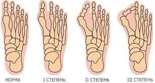 Степени деформации стопы 