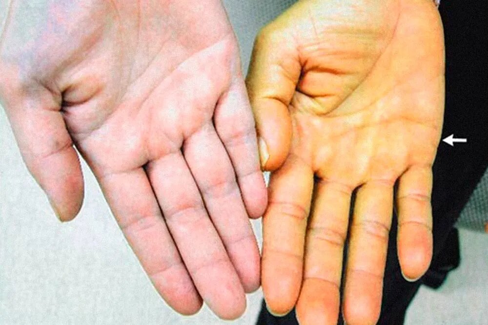 Каротинемия