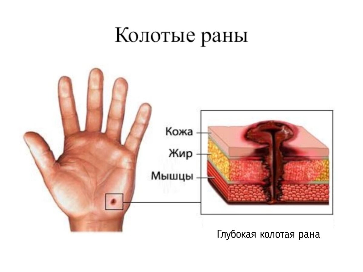 Сколько заживает глубокий. Глубокая колотаятрана. Колотая рана и резаная рана.