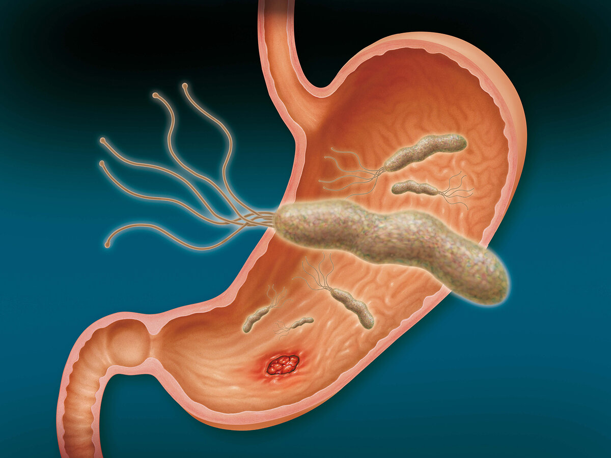 Хеликобактер пилори (Хеликобактериоз) - симптомы и лечение у взрослых