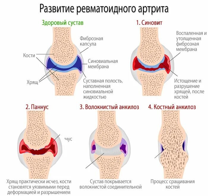 Боли в суставах (комплекс анализов)