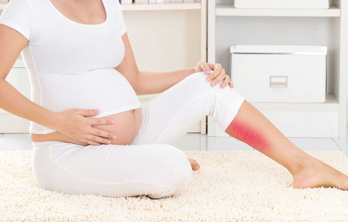 После кесарева отекают ноги что делать. Беременность при варикозе. Расширение вен у беременных.