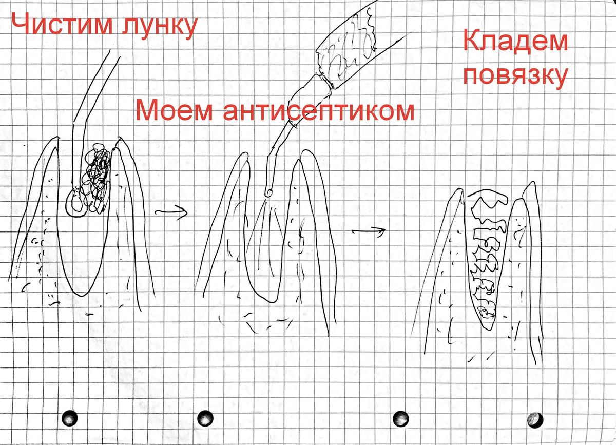 Болит десна после удаления зуба: норма или патология? Почему это происходит и что предпринять.