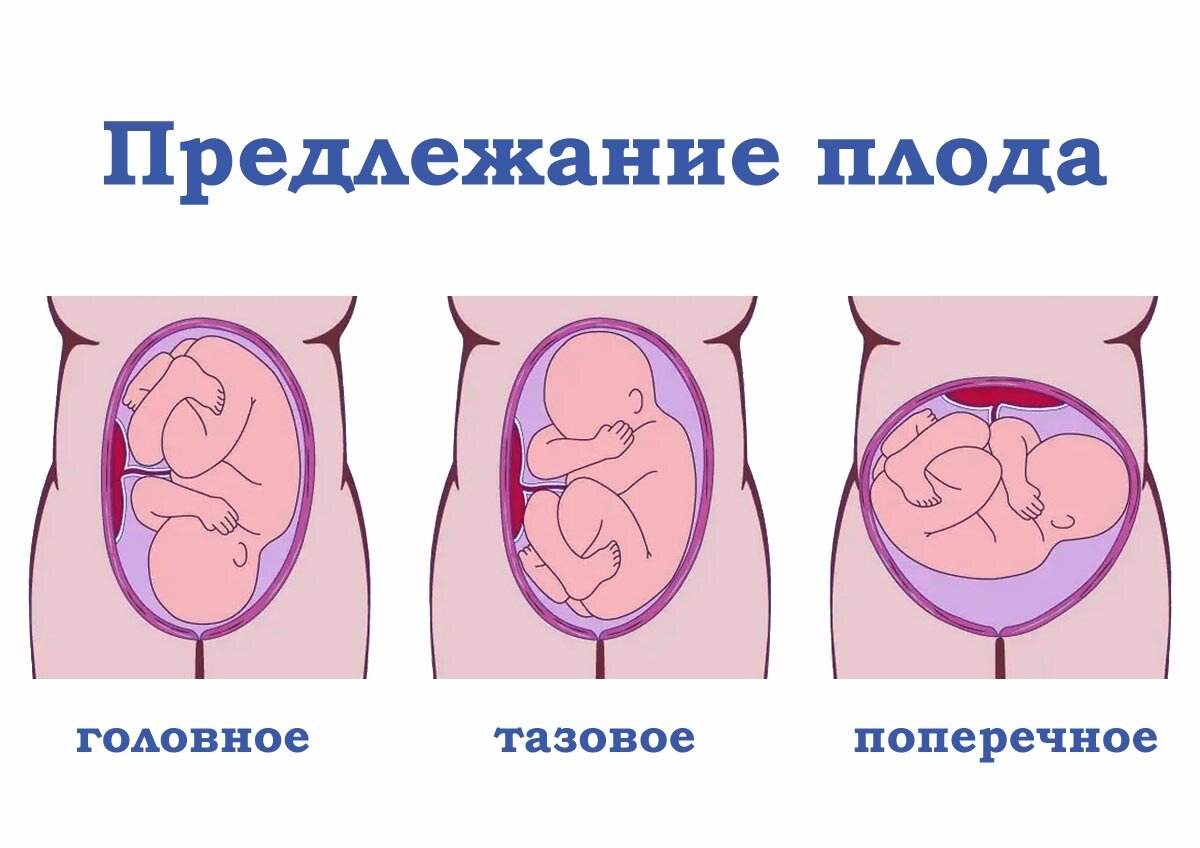 Головное предлежание плода – что это, причины, симптомы, диагностика и лечение в «СМ-Клиника»