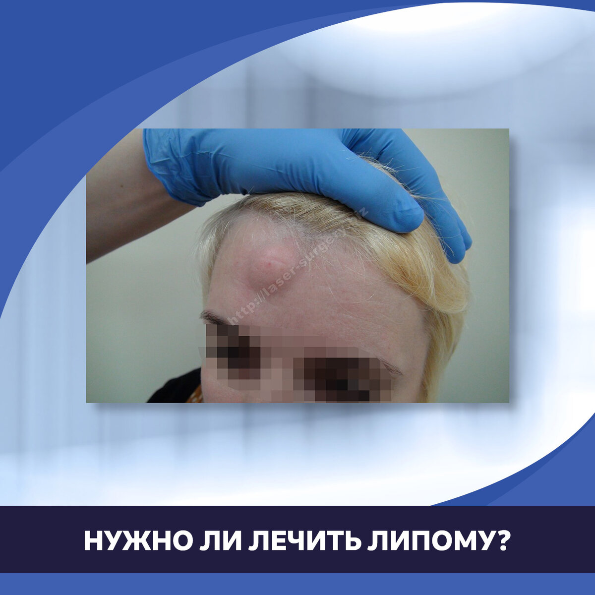 Нужно ли лечить липому? | Медицинский центр «АТЛАНТиК» | Дзен