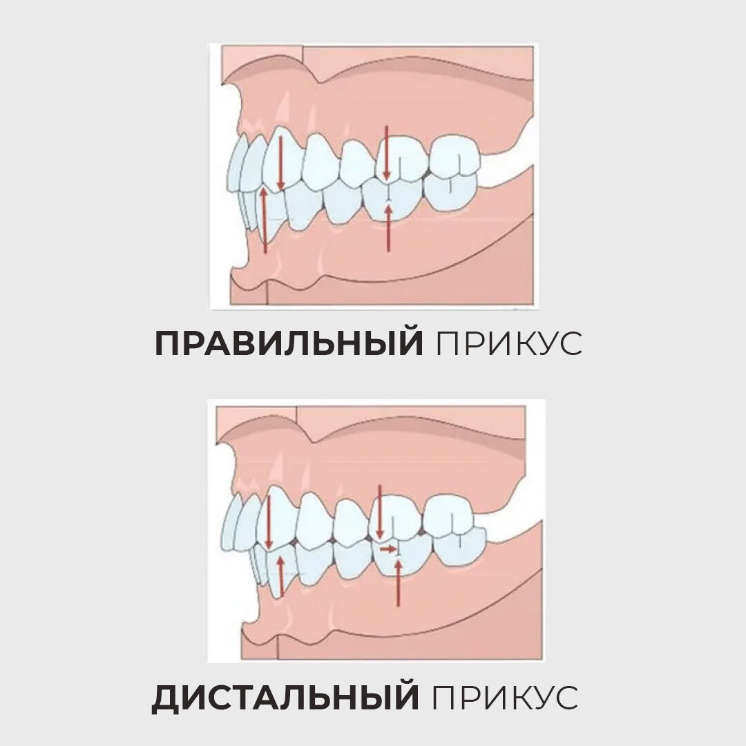 Дистальный прикус и его лечение | АМ Клиник | Стоматология | Дзен