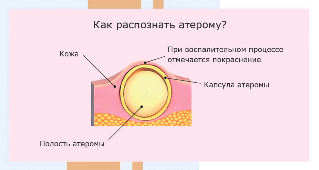 Как распознать атерому