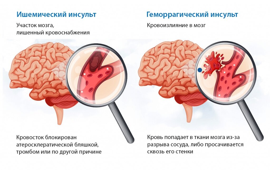 Острое нарушение мозгового кровообращения геморрагический инсульт. Виды инсульта ишемический и геморрагический. Ишемический инсульт и геморрагический инсульт. Типы геморрагического инсульта.