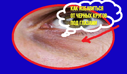 как избавиться от черных кругов под глазами народными средствами