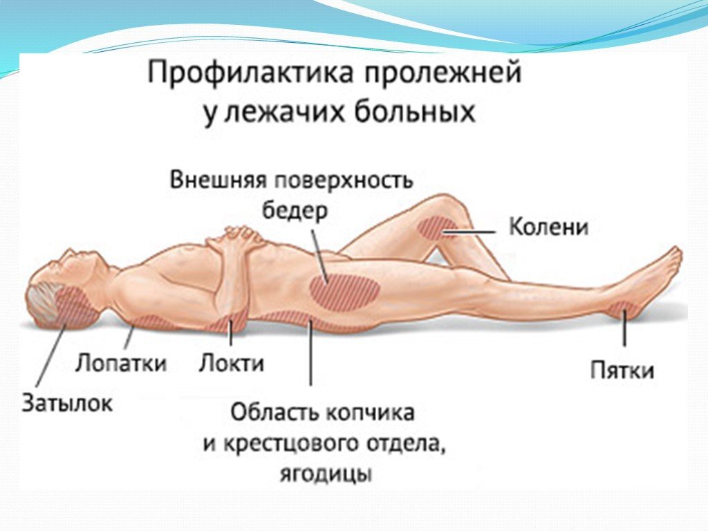 Профилактика пролежней картинки