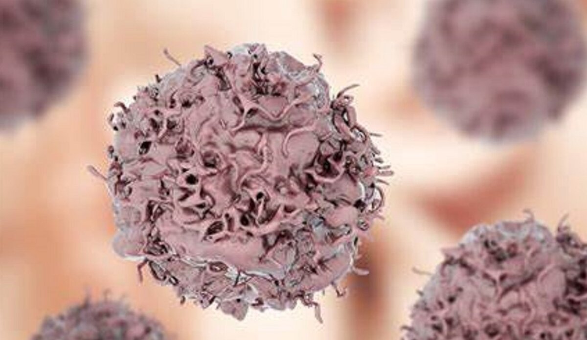 РАСПАД ОПУХОЛИ В РЕЗУЛЬТАТЕ ЛЕЧЕНИЯ | Онкология понятным языком. Доктор ...