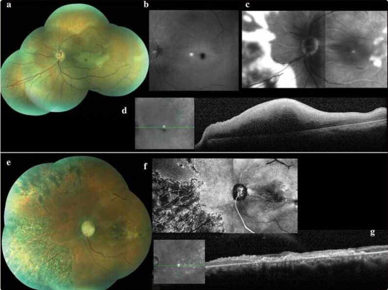 Рисунок 1. Левый глаз (а) цветная фотография глазного дна при осмотре,  показывающая сегментарное сужение артерий сетчатки с эмболом в сосудах  сетчатки, вишнево-красное пятно в макуле и ослабленные вены сетчатки.
(b) Флуоресцентная ангиограмма при поступлении пациентки, демонстрирующая блокировку ретинального кровообращения.
(c) Флюоресцентная ангиограмма через три дня, показывающая  ограниченное и вялое заполнение артерий сетчатки и позднюю  гиперфлюоресценцию в сетчатке и перифовеальной области.
(d) Изображение оптической когерентной томографии левого глаза через три дня, показывающее увеличение толщины макулы сетчатки.
Через месяц: (e) Цветная фотография глазного дна, показывающая  бледный диск зрительного нерва с пигментом в верхней височной области,  фантомные сосуды сетчатки, пигментацию периферической части сетчатки и  макулярный фиброз.
(f) Флуоресцентная ангиограмма, демонстрирующая истончение сосудов  сетчатки и область гипофлуоресценции, смешанную с участками умеренной  гиперфлюоресценции в промежуточной области сетчатки и макулы.
(g) Изображение оптической когерентной томографии, демонстрирующее атрофию всех слоев сетчатки и фиброз макулярной области.