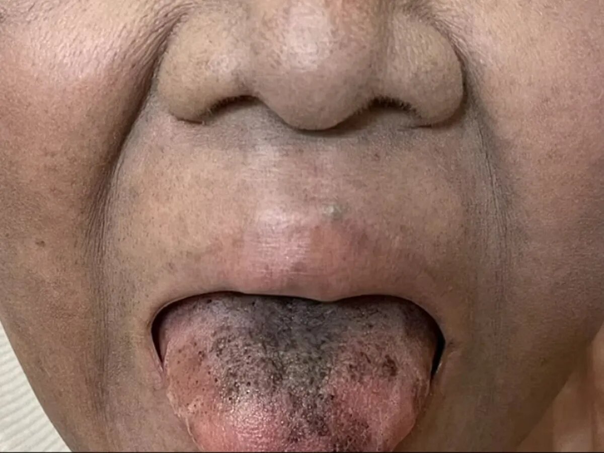 У 60-летней женщины из Фукуока на юге Японии через четыре месяца после перехода на препарат появился ковер из болезненных черных и коричневых волос. Ей поставили диагноз «черный волосатый язык»
