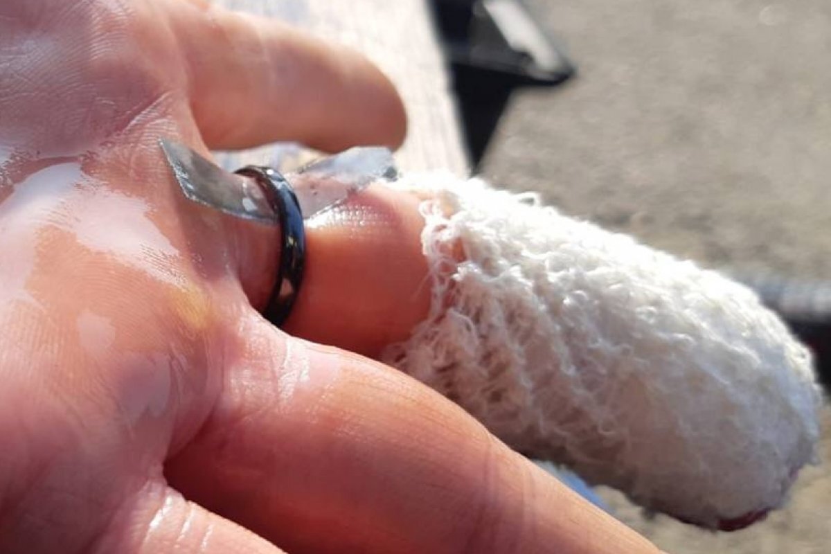    В Томске спасатели сняли два кольца с травмированного пальца девушки