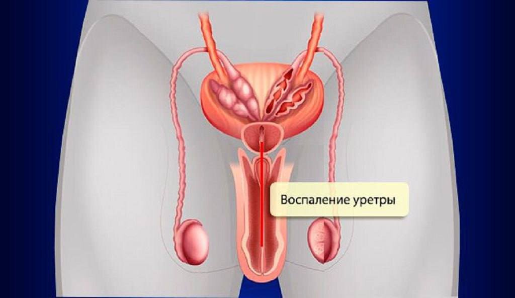 Уретрит у женщин. Воспаление мочеиспускательного канала. Воспаление мочеполового канала.