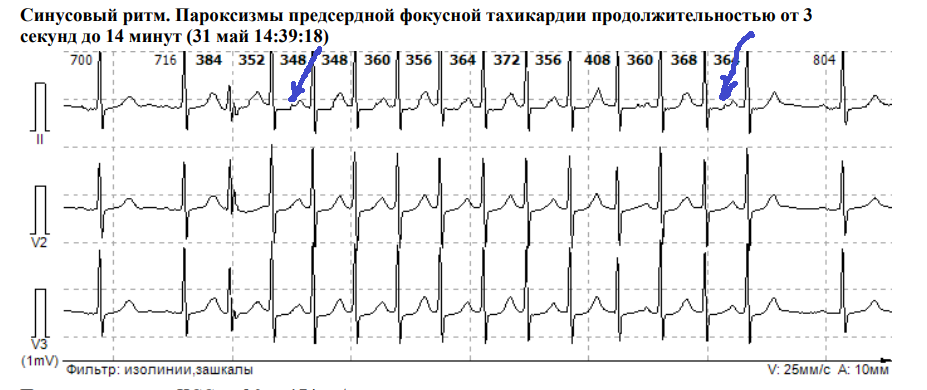 Стрелки указывают на проглядывающие то там, то сям предсердные зубцы Р, доказывающие, что это именно предсердная тахикардия