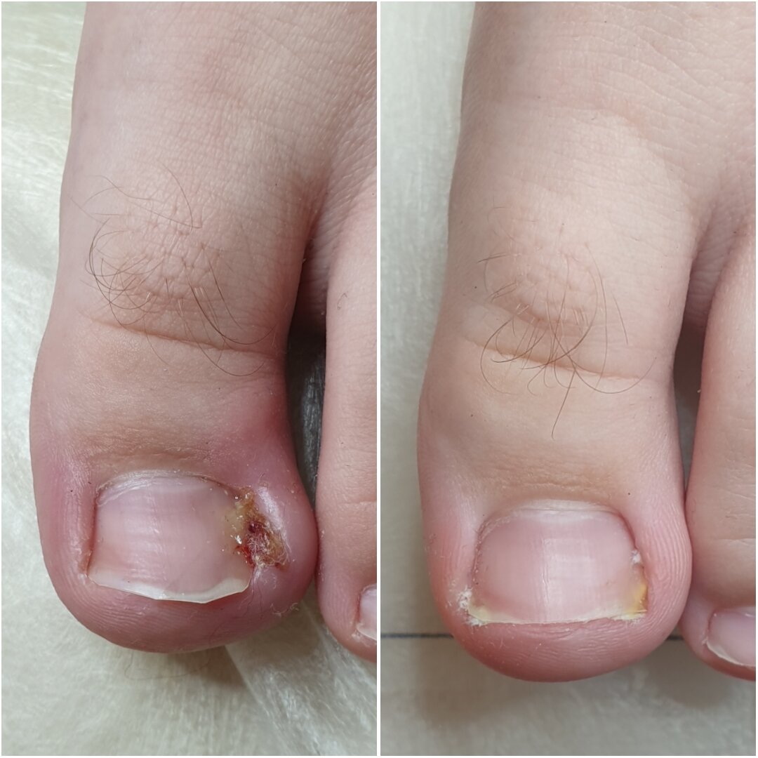 Вросший ноготь до и после лечения в Центре подологии.