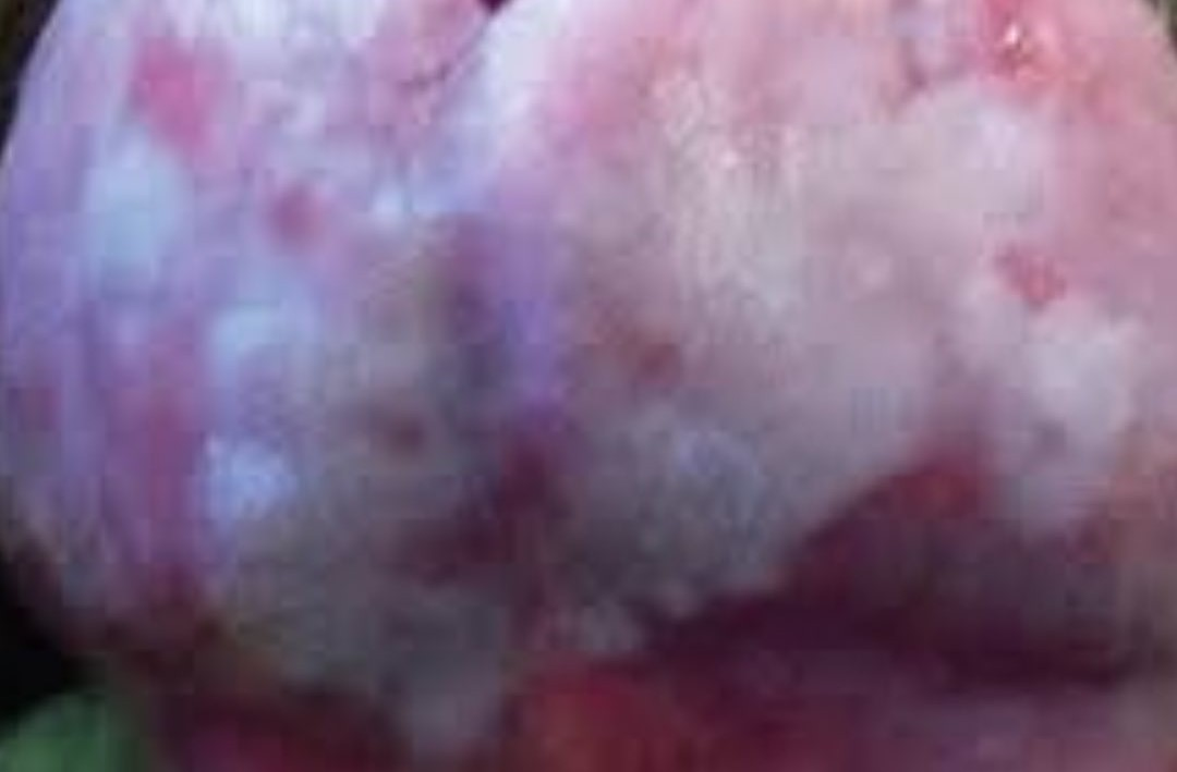 Очаги склероза в области головки полового члена