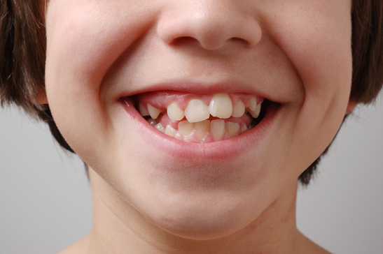 Нежная ортодонтия: почему у ребенка криво растут зубы и как с эти справиться?