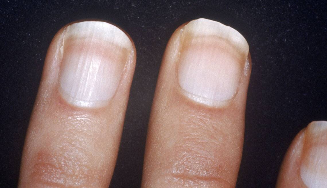 Полосы на ногтях что значит. Меланонихия грибковая.