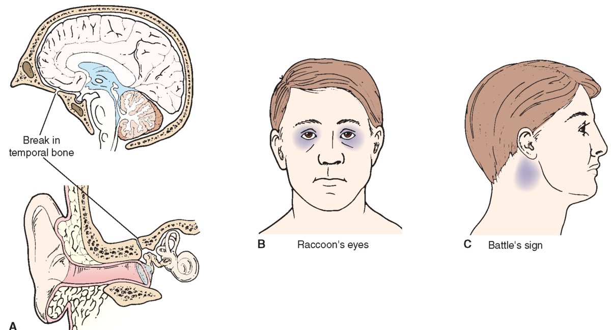 Нос и головной мозг. Перелом основания черепа симптом очков. Симптом очков при переломе основания черепа. Перелом основания черепа ликворея. Перелом основания черепа симптомы.