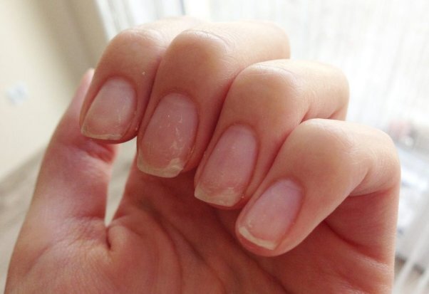 Ломкие ногти