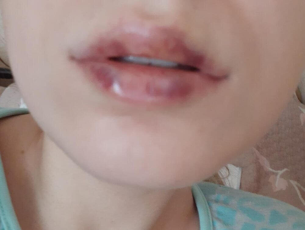 Посинение губ