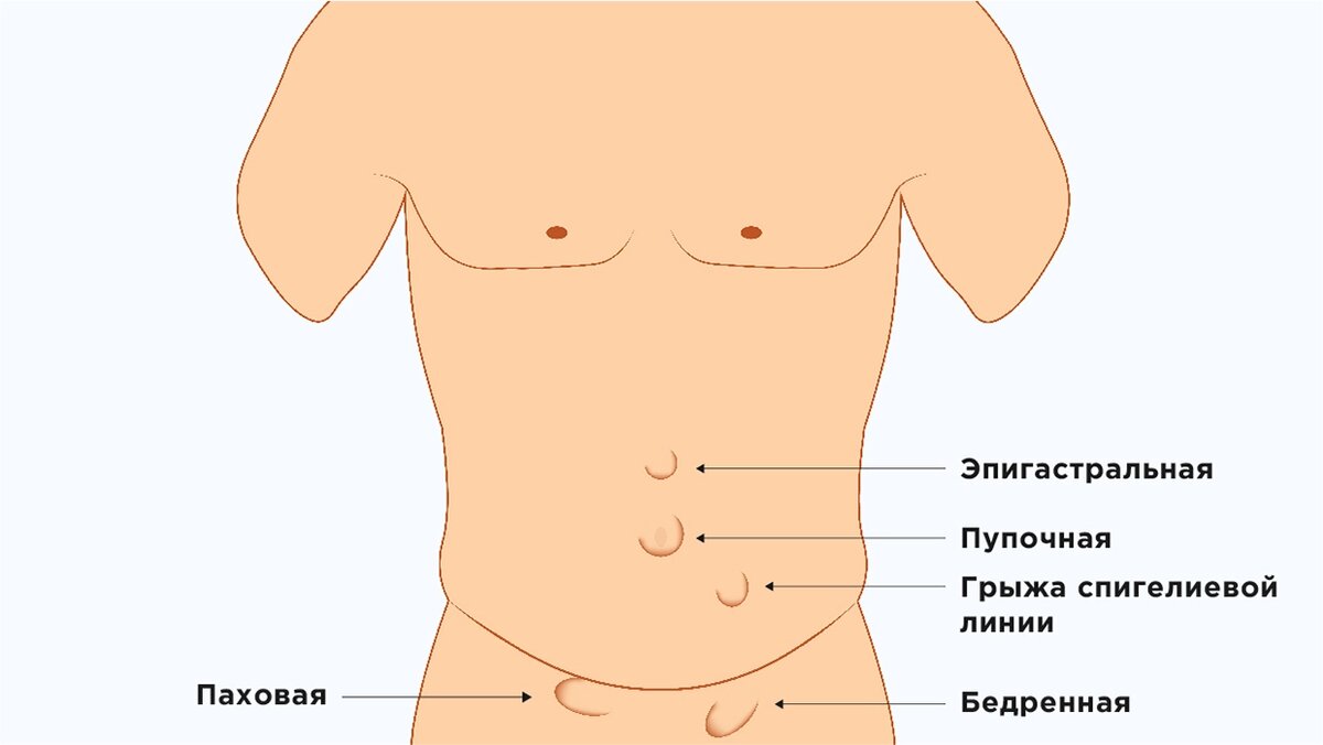 Лечение грыжи живота