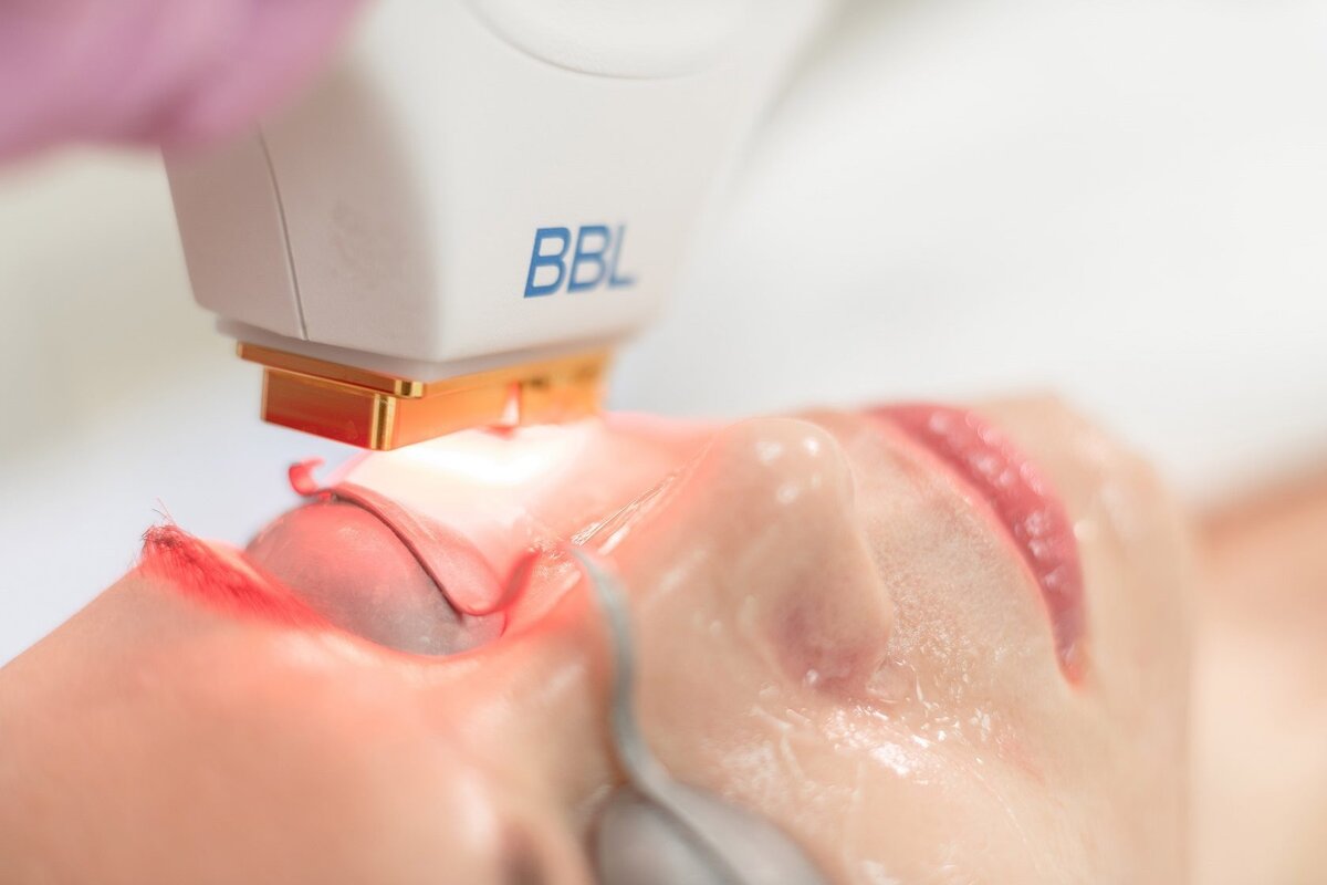 Процесс процедуры "Фотоомоложение"