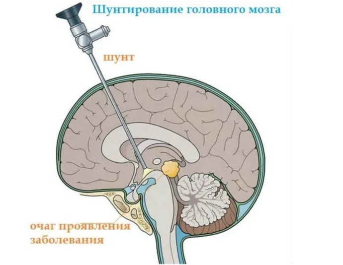 Гидроцефалия - Проблемы со здоровьем у детей - Справочник MSD Версия для потребителей