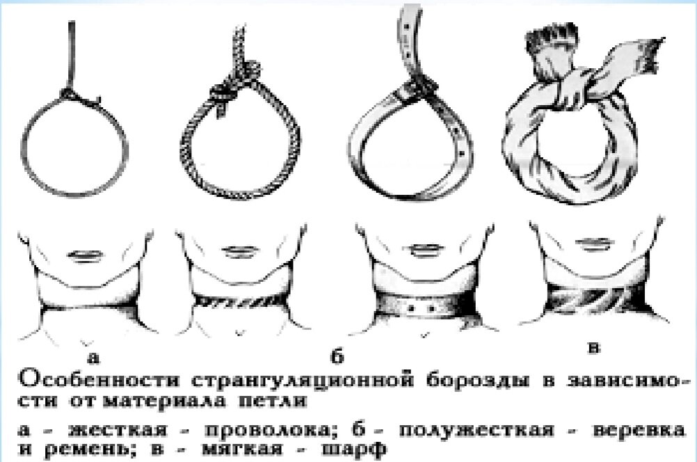 Странгуляционная асфиксия. Странгуляционная борозда. Странгуляционная борозда на шее. Странгуляционная борозда схема.