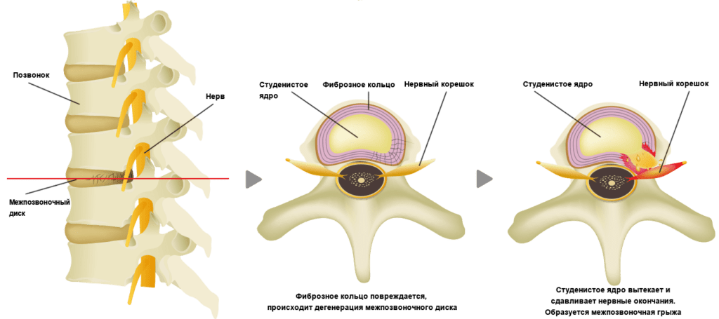 Что такое грыжа межпозвоночного диска? О грыже позвоночника знают все. Межпозвоночные диски состоят из студенистого ядра и внешнего фиброзного кольца.