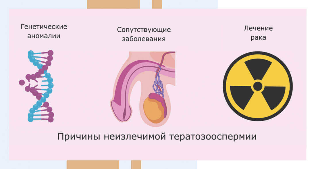 Причины необратимой тератозооспермии