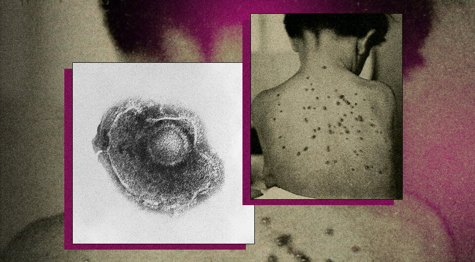   N + 1; CDC / Dr. Erskine Palmer / B.G. Partin; The diseases of infants and children by Griffith, J. P. Crozer, 1919 / Public domain
