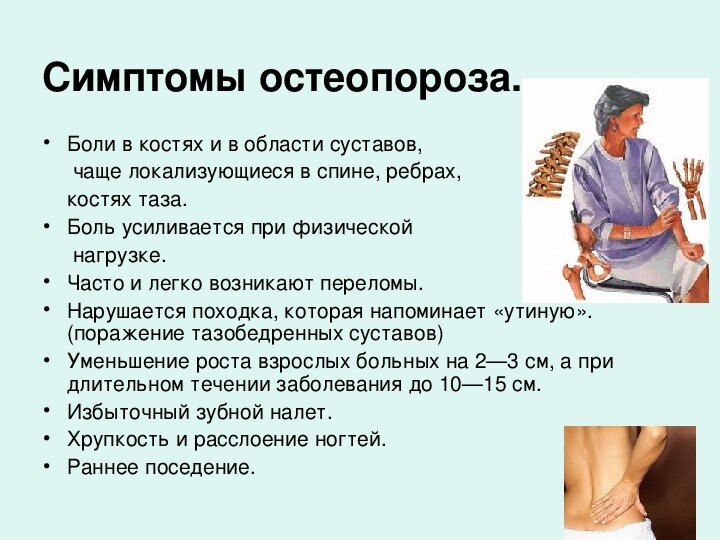 Остеопороз – симптомы и лечение остеопороза, профилактика