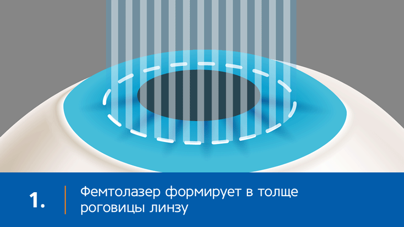      Этапы лазерной коррекции зрения СмартСайт